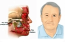 Yüz Siniri Felci Belirtileri ve Tedavisi
