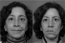 Yüz Felci Nasıl Anlaşılır?